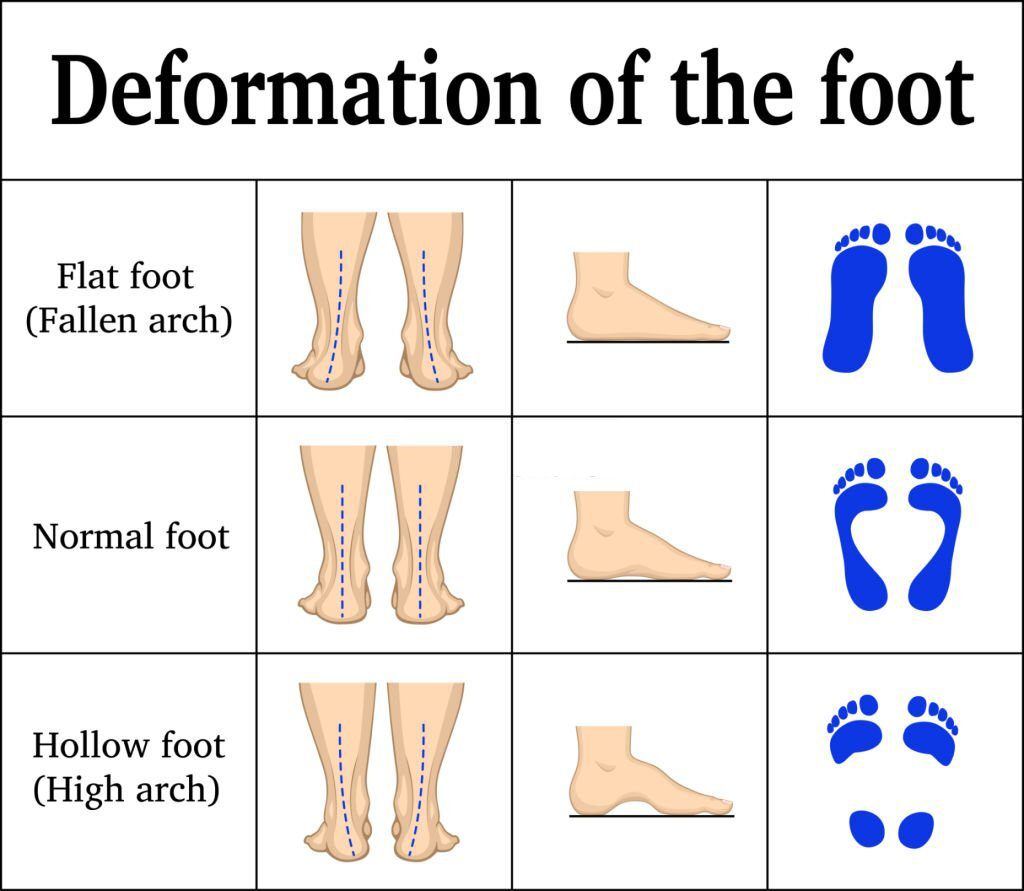 Superfoot Downloader.la-6249491aa69fd Why go with custom insoles?  